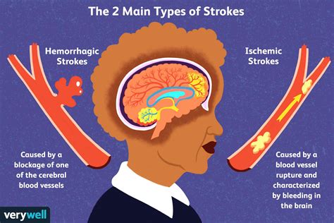 About stroke .